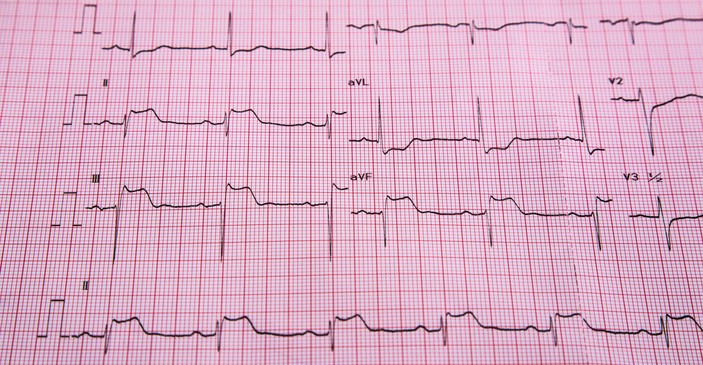 ECG - STEMI - semne de supradenivelare ST și infarct al mușchiului cardiac