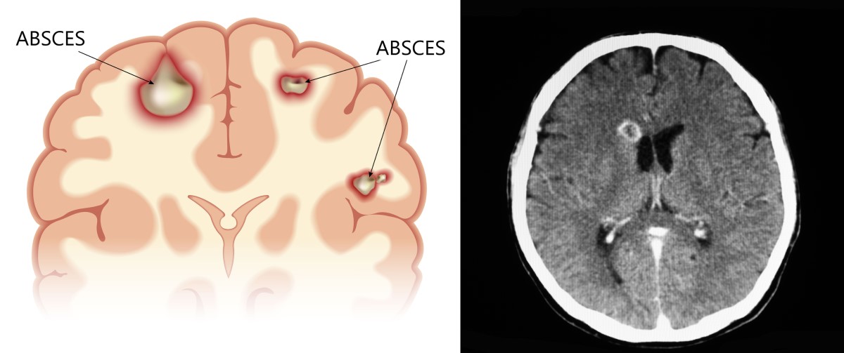 Vizualizări anatomice și scanări CT ale unui abces cerebral