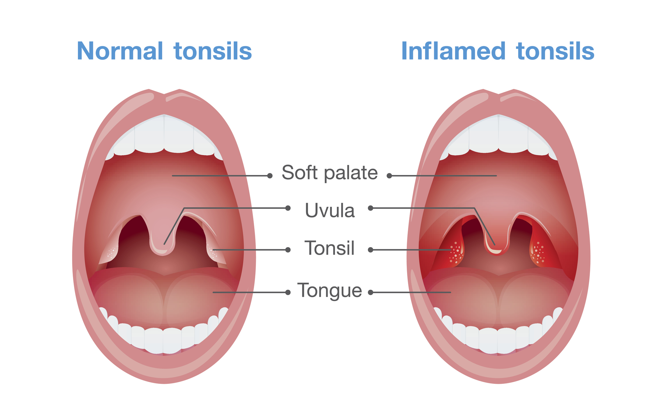 Angina - inflamația amigdalelor