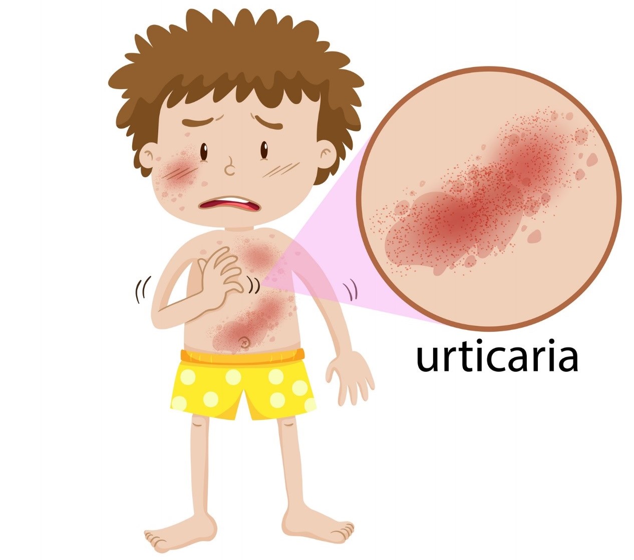 Animație - un băiat cu o erupție cutanată pe tot corpul, înroșirea pielii, urticarie