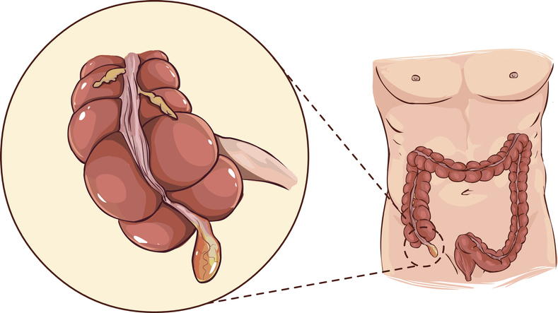 Apendice - reprezentare anatomică la începutul colonului