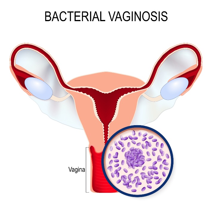 Vaginoza bacteriană și supracreșterea Gardnerella vaginalis