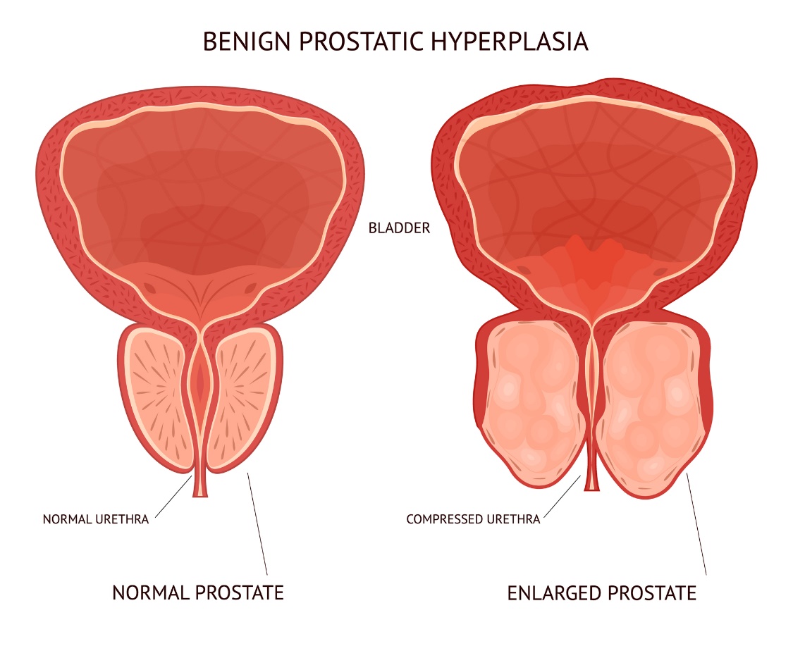 Hiperplazia prostatică benignă