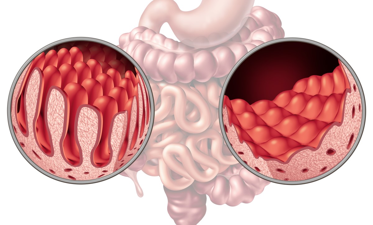 Gut și vilozitățile, unde sunt absorbite substanțele nutritive, comparație: sănătoase și deteriorate de boala celiacă