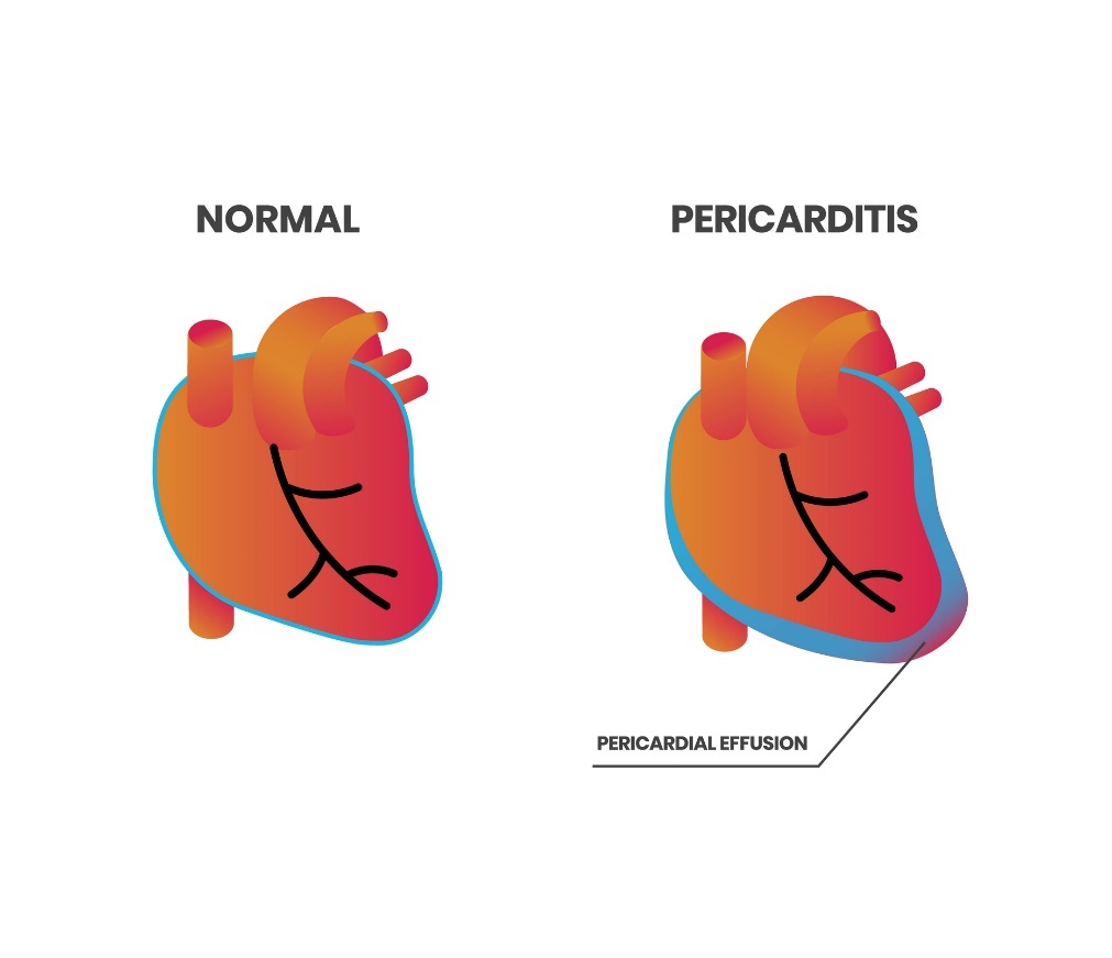 Fiziologie cardiacă și pericardită (efuziune pericardică)