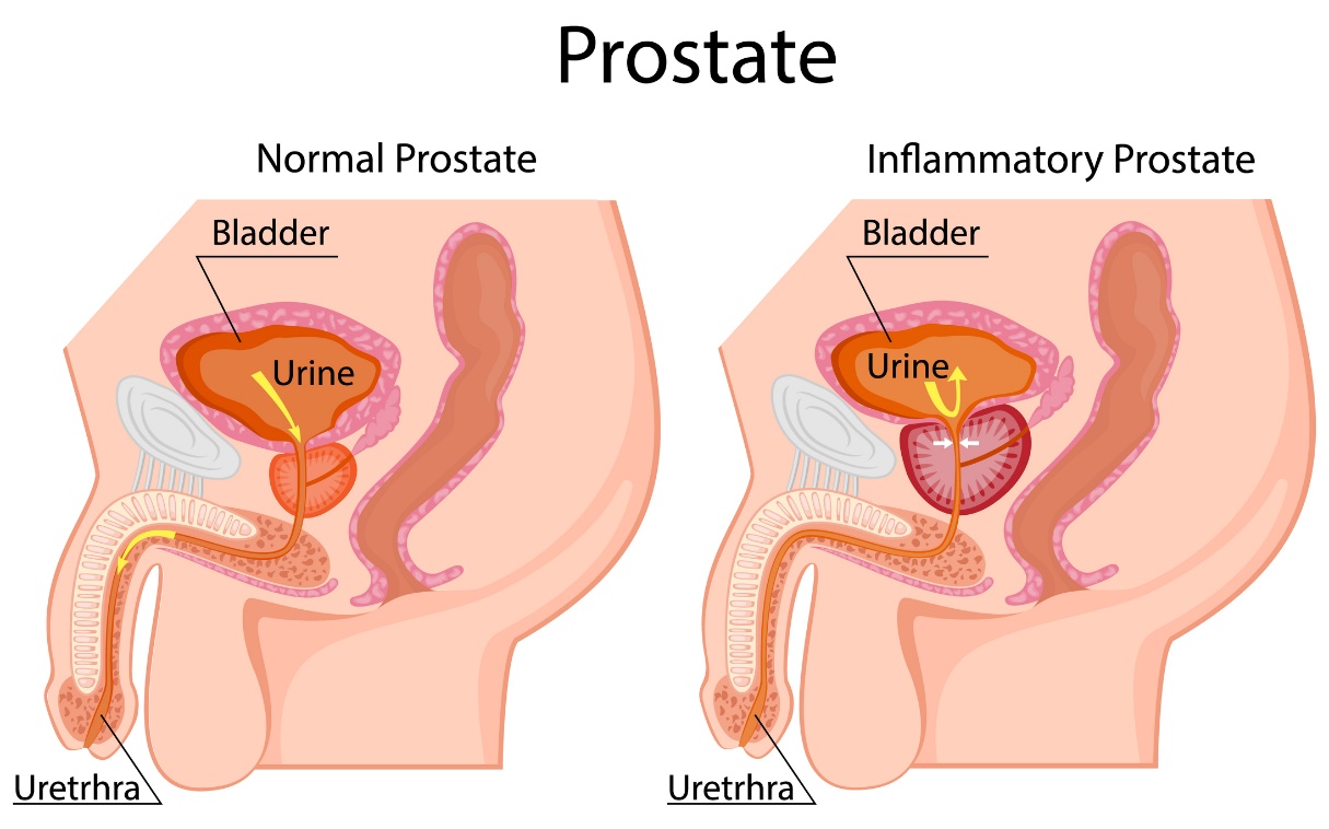 Stânga: prostată fiziologică. Dreapta: prostată mărită. Situată sub vezica urinară. Vezică, urină, uretră.