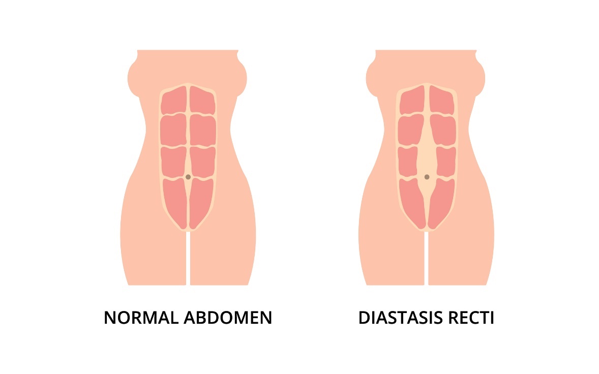 Starea fiziologică a mușchilor abdominali și diastaza (distanțarea) mușchilor drepți abdominali stâng și drept față de linia mediană a liniei albe