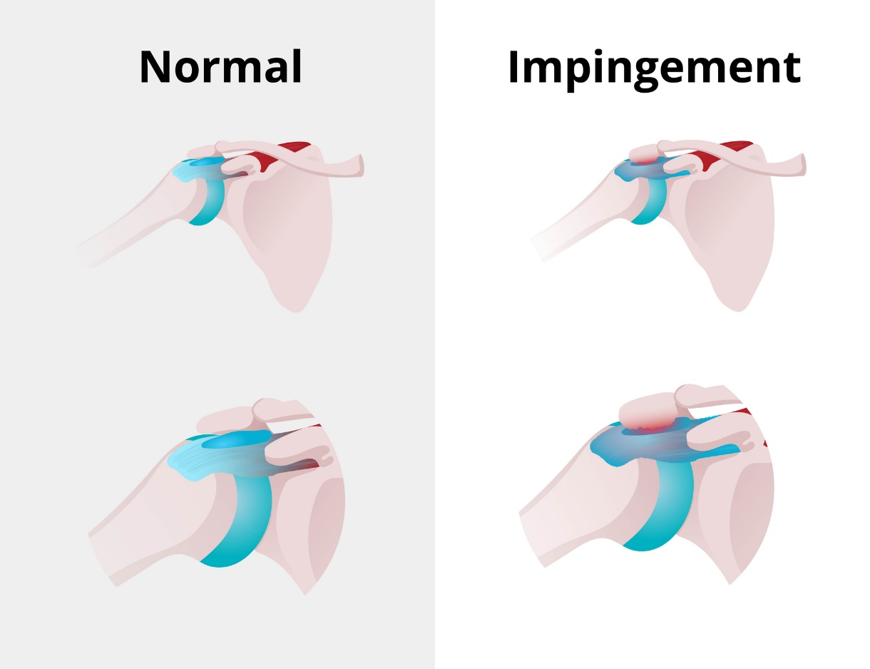 Starea fiziologică a articulației umărului și a sindromului de impingement