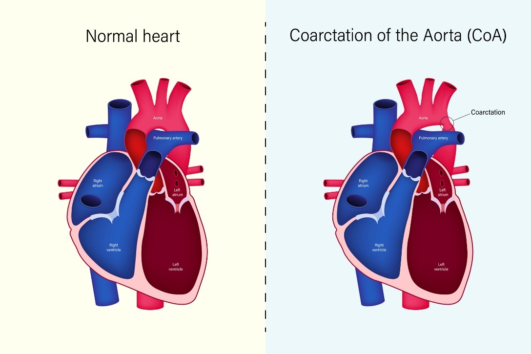 Starea fiziologică a inimii și coarctația de aortă (CoA)