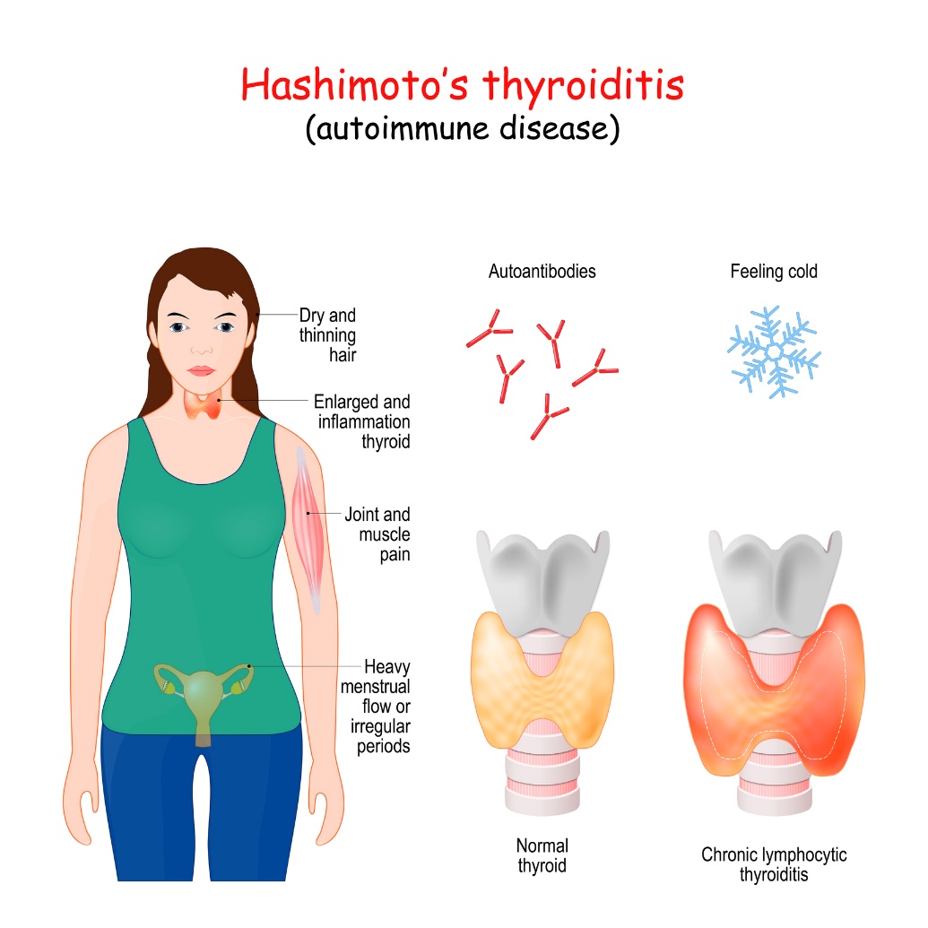 Tiroidita Hashimoto și simptomele clinice