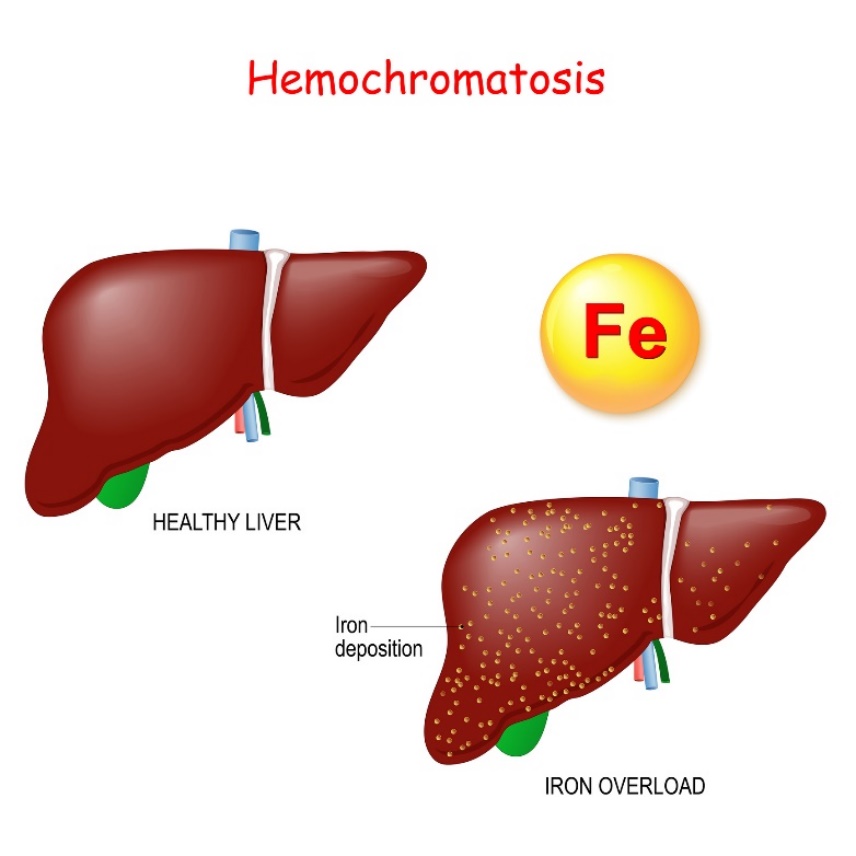 Hemocromatoza: fiziologia și patologia ficatului cu depunere excesivă de fier (Fe)