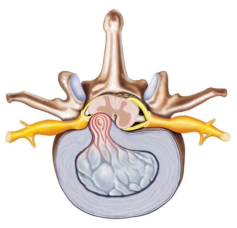 Hernia de disc - reprezentare anatomică