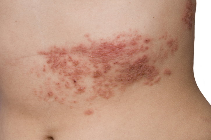 Herpes zoster pe abdomen