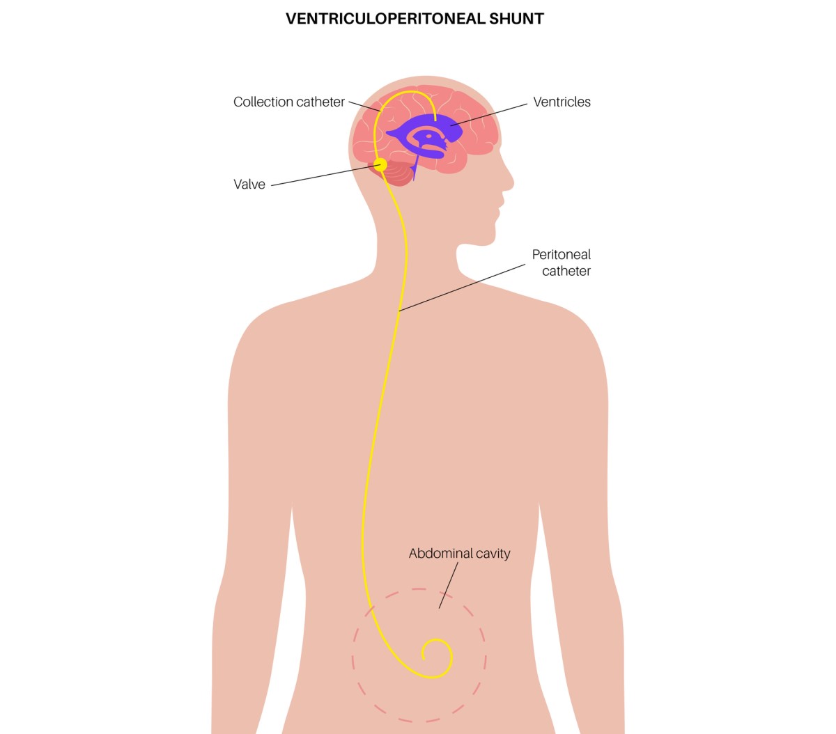 Ilustrație a unui șunt ventriculo-abdominal care drenează excesul de lichid din creier în cavitatea abdominală.