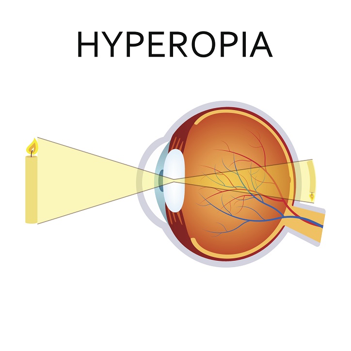 Hipermetropie