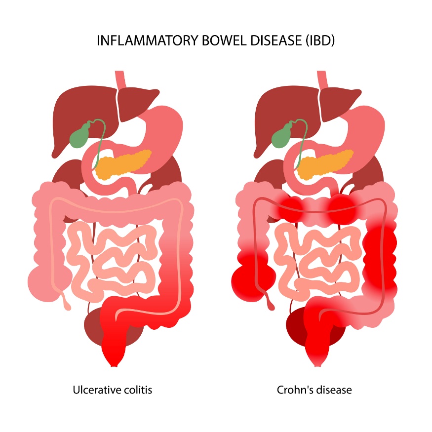 IBD: împărțirea în colită ulcerativă și boala Crohn în funcție de localizarea reacției inflamatorii.