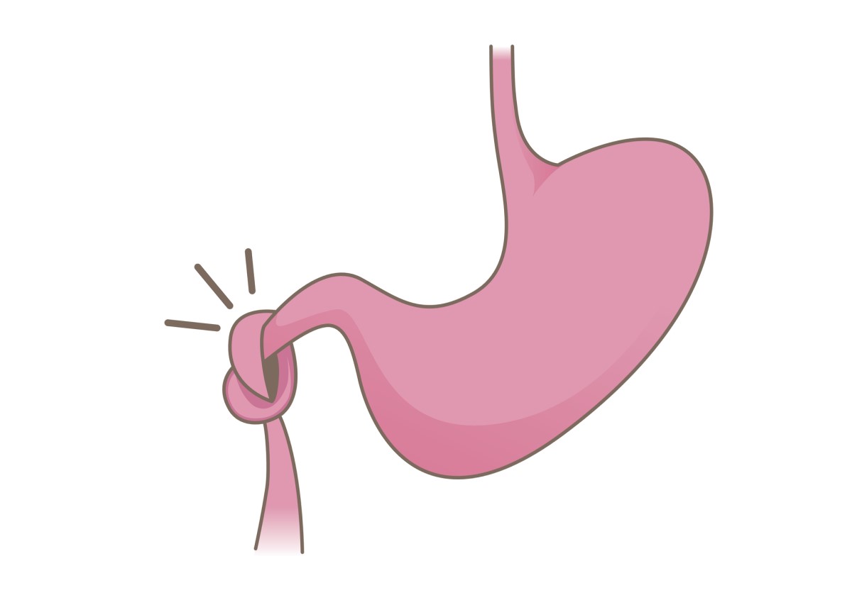 animație de intestin strangulat și obstrucție intestinală - ileus al intestinului subțire și stomac peste intestin.