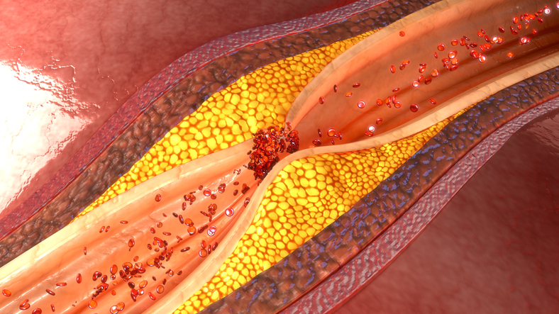 Angina pectorală și ateroscleroză și placă aterosclerotică în vasul coronarian sau cardiac