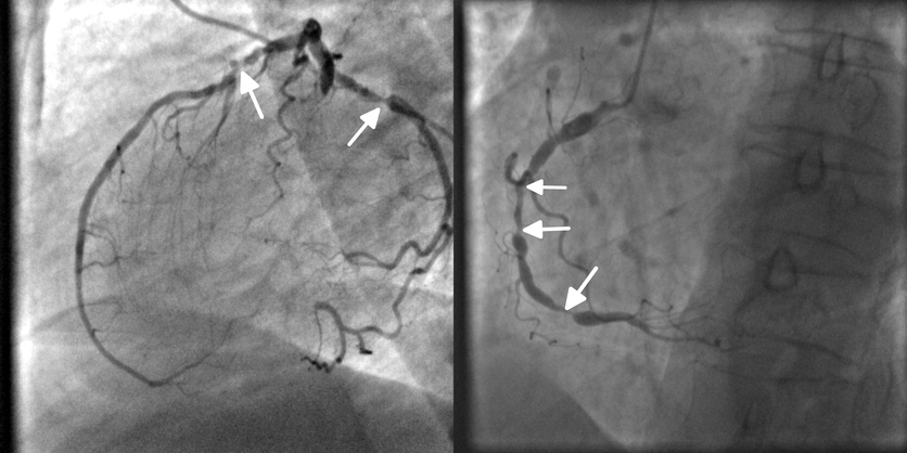 Coronarografie, angiografie, obstrucție coronariană