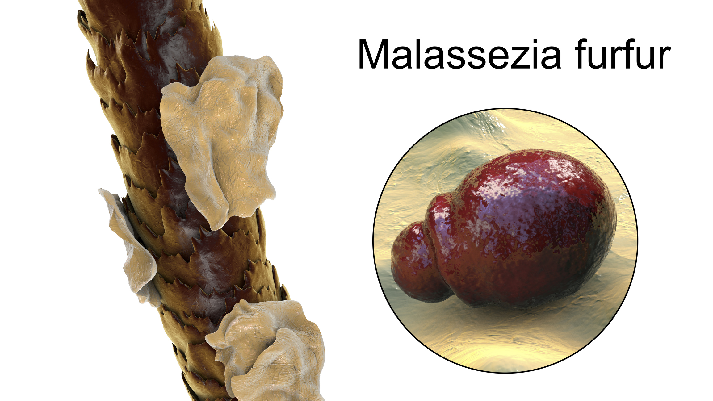 Malassezia furfur