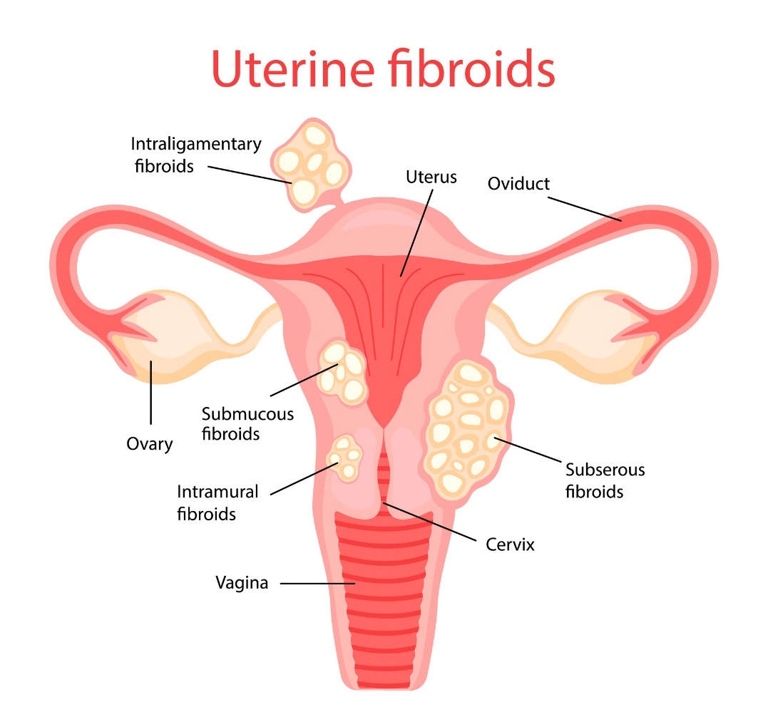 fibroame uterine