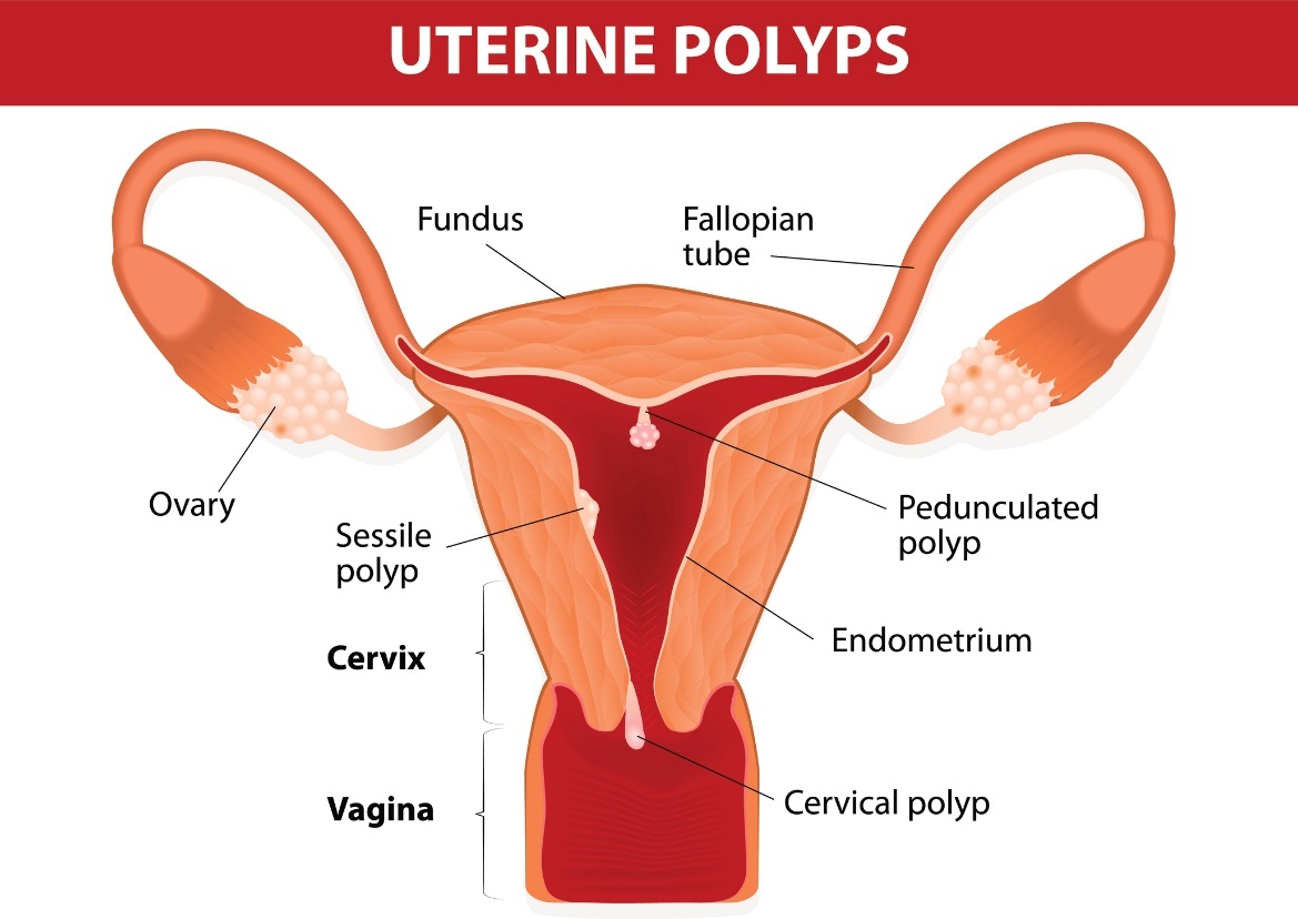 Polipi uterini