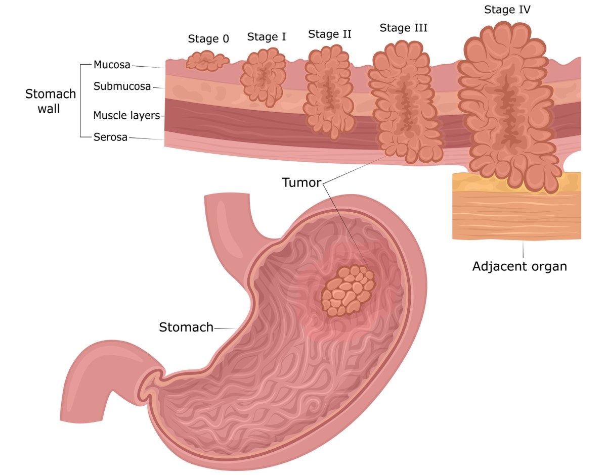 Cancerul gastric: straturile peretelui stomacal (mucoasă, submucoasă, mușchi, seroasă) și stadiile de dezvoltare a tumorii, de la mucoasă la împrejurimi și organe.