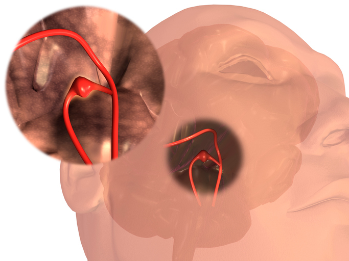 Anevrism al unui vas de sânge cerebral