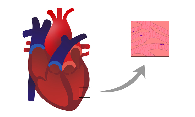 Miocardita: un proces inflamator cu infiltrat și degenerare a cardiomiocitelor din peretele mușchiului cardiac.