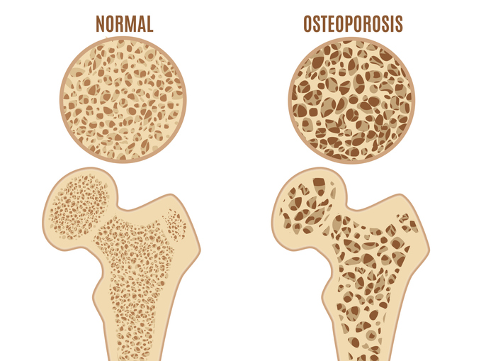 Osteoporoză a femurului