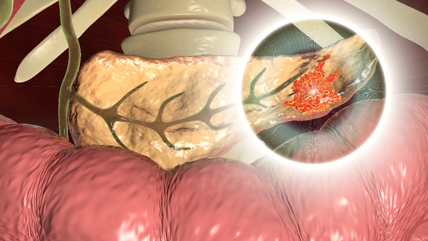 Pancreatită - partea infectată a pancreasului - coada pancreasului, vedere anatomică