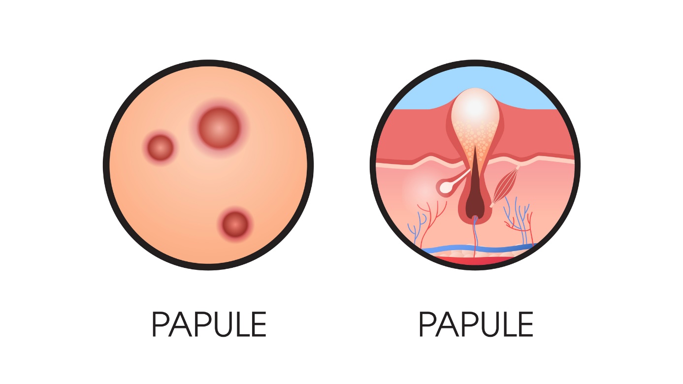 papulă pe piele