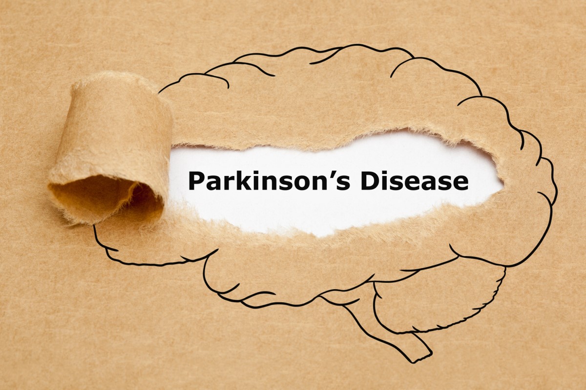 Morbus parkinson = Parkinsons disease = boala Parkinson - animație a unui creier cu boala Parkinson în mijloc