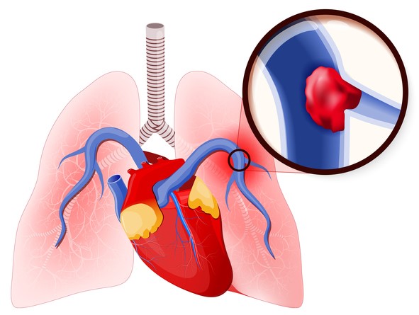 Embolia pulmonară, închiderea arterei pulmonare de către un cheag de sânge