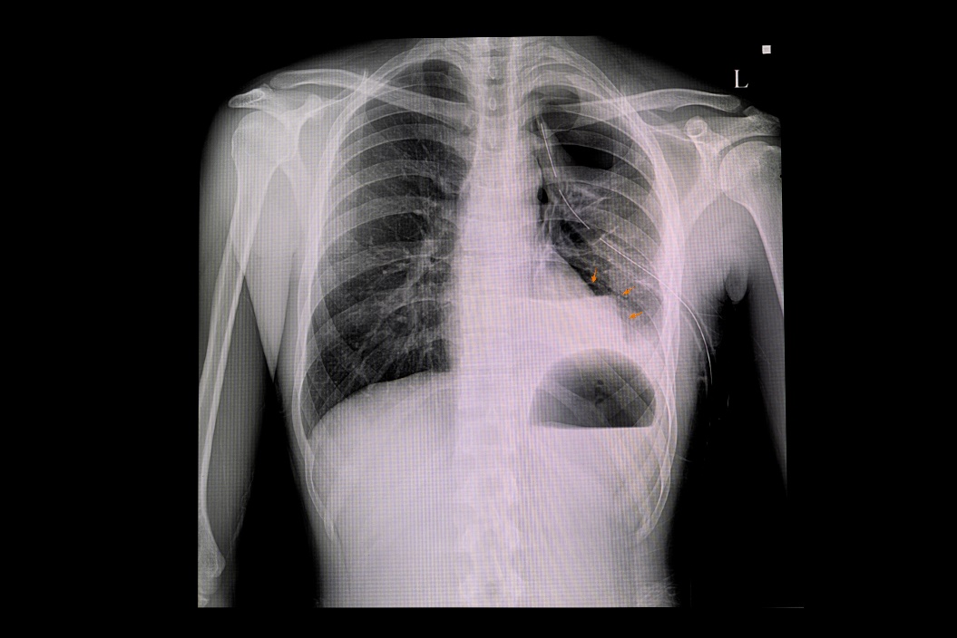 Radiografie de pneumotorax al plămânului stâng și acumularea de aer în cavitatea pleurală a toracelui (culoare albă)