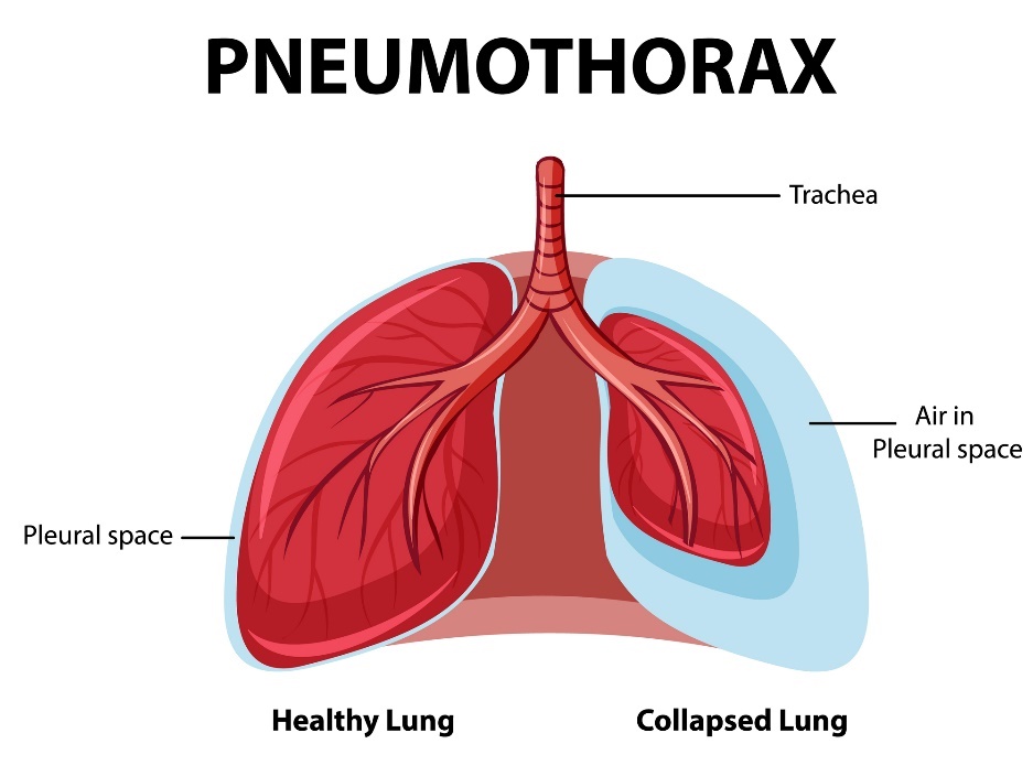 Pneumotorax: plămâni sănătoși și colapsanți