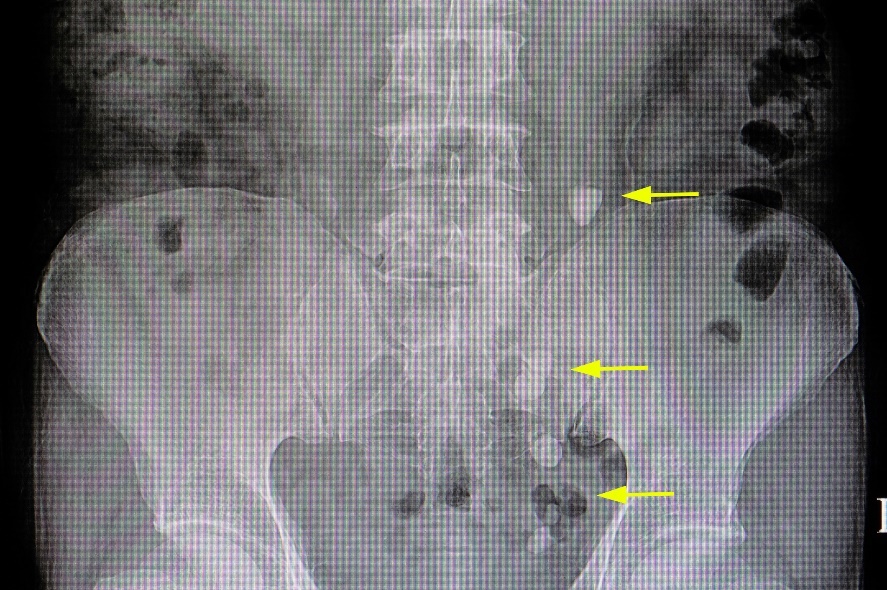 Radiografie: numeroase concrețiuni în cursul tractului urinar