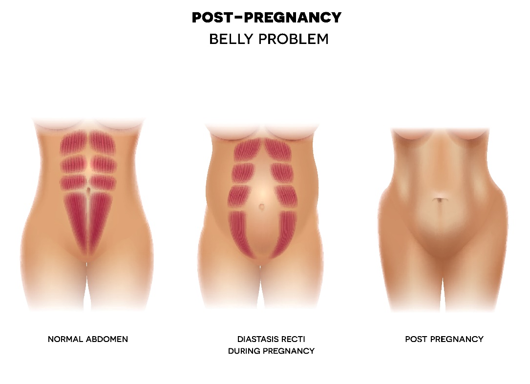 Diastaza postpartum a peretelui abdominal