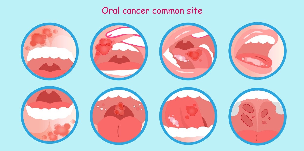 Cancerul oral și depozitele tumorale - un model