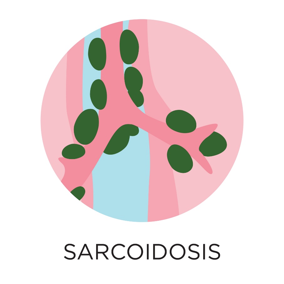 Sarcoidoza - formarea de granuloame