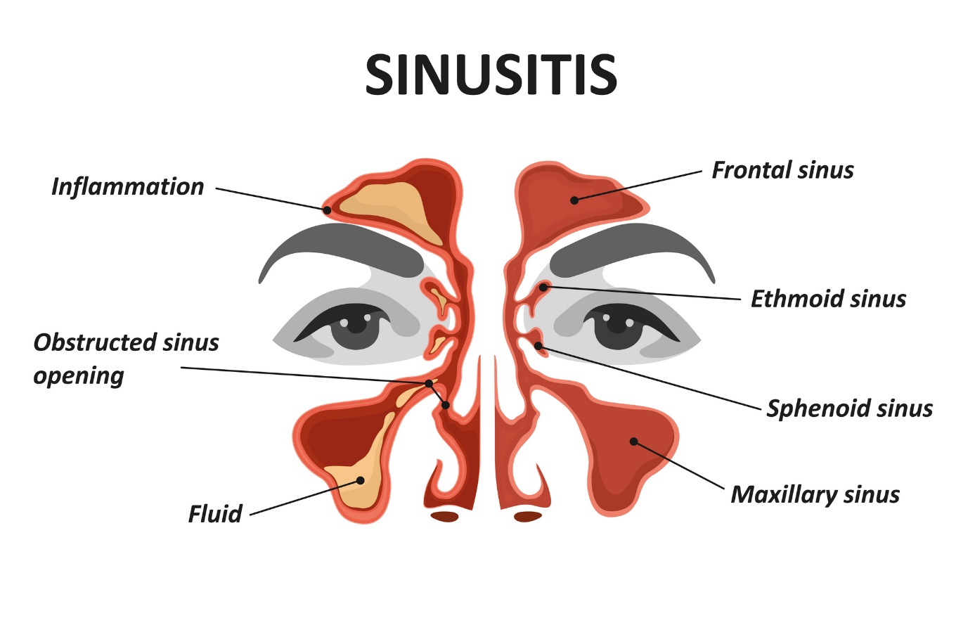 Modelul/imaginea animată a sinuzitei și a sinuzitei