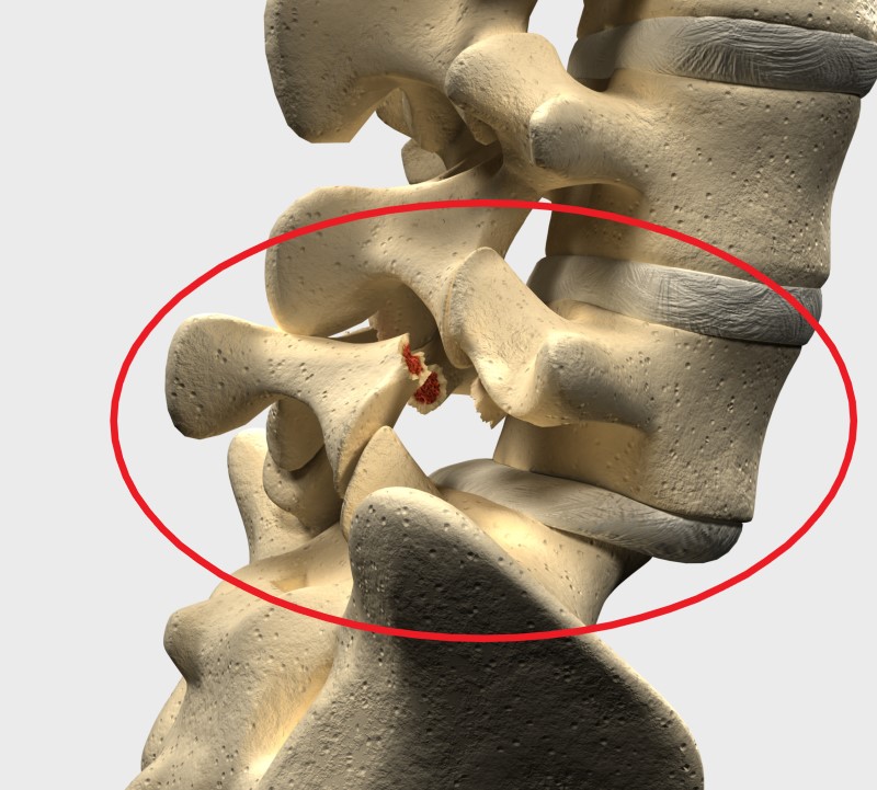 Spondilolistezis în regiunea lombară L5 și S1 - model de schelet spinal