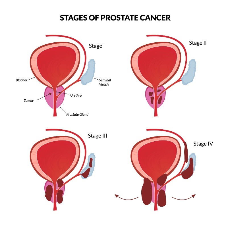 4 stadii de bază ale cancerului de prostată