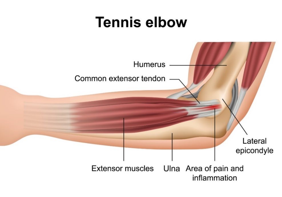 Cotul de tenis (epicondilită laterală): oasele articulației cotului, extensorii mușchilor antebrațului, epicondilul lateral și locul durerii primare.