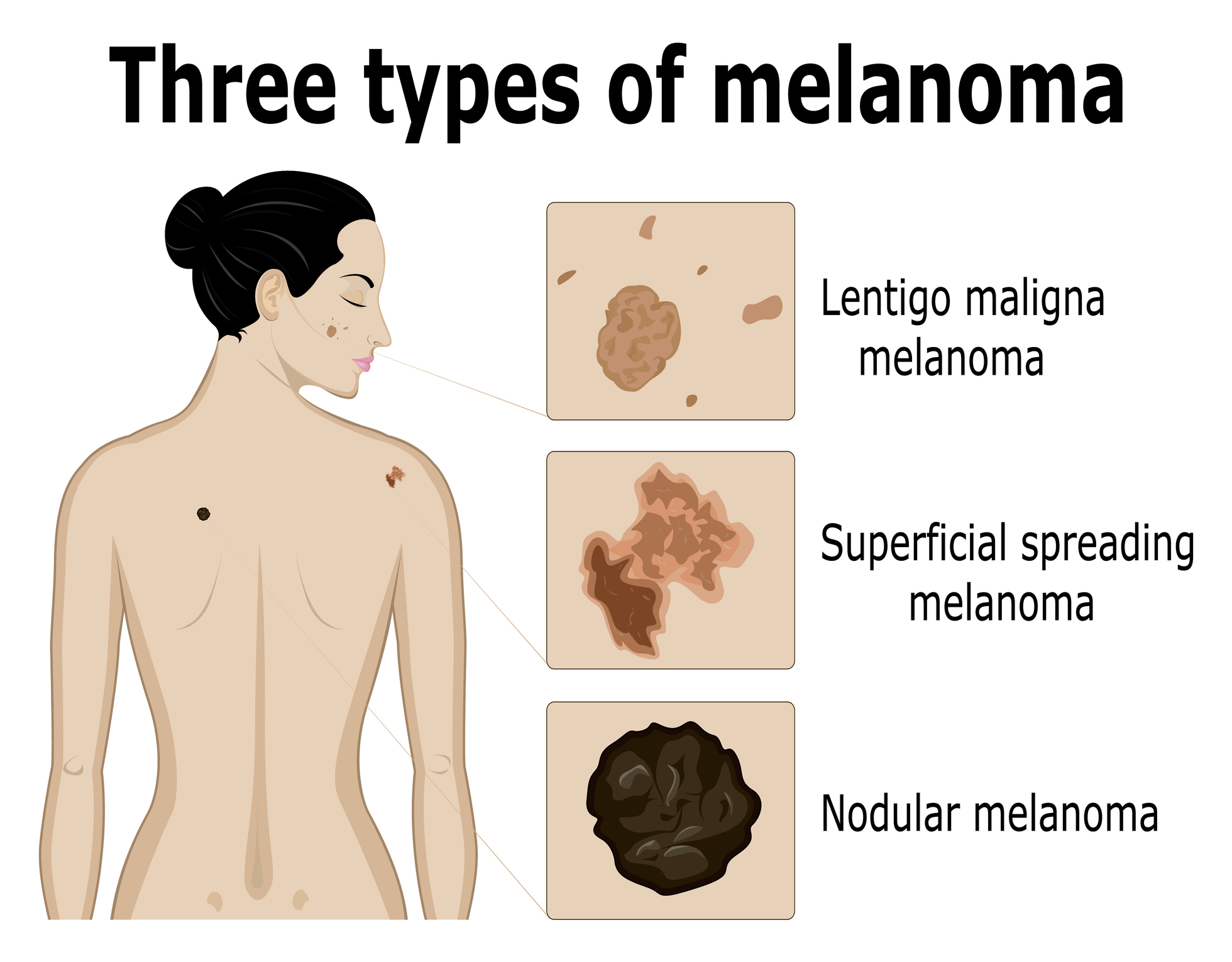 Imagistica celor trei tipuri de melanom