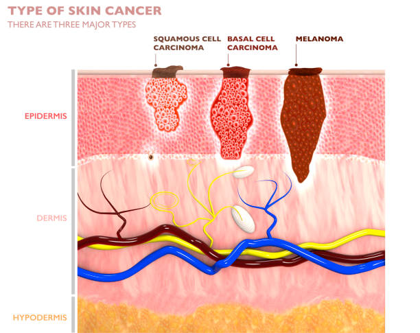 Tipuri de tumori cutanate, pătrunderea lor în piele - carcinomul cu celule scuamoase, bazaliomul și melanomul