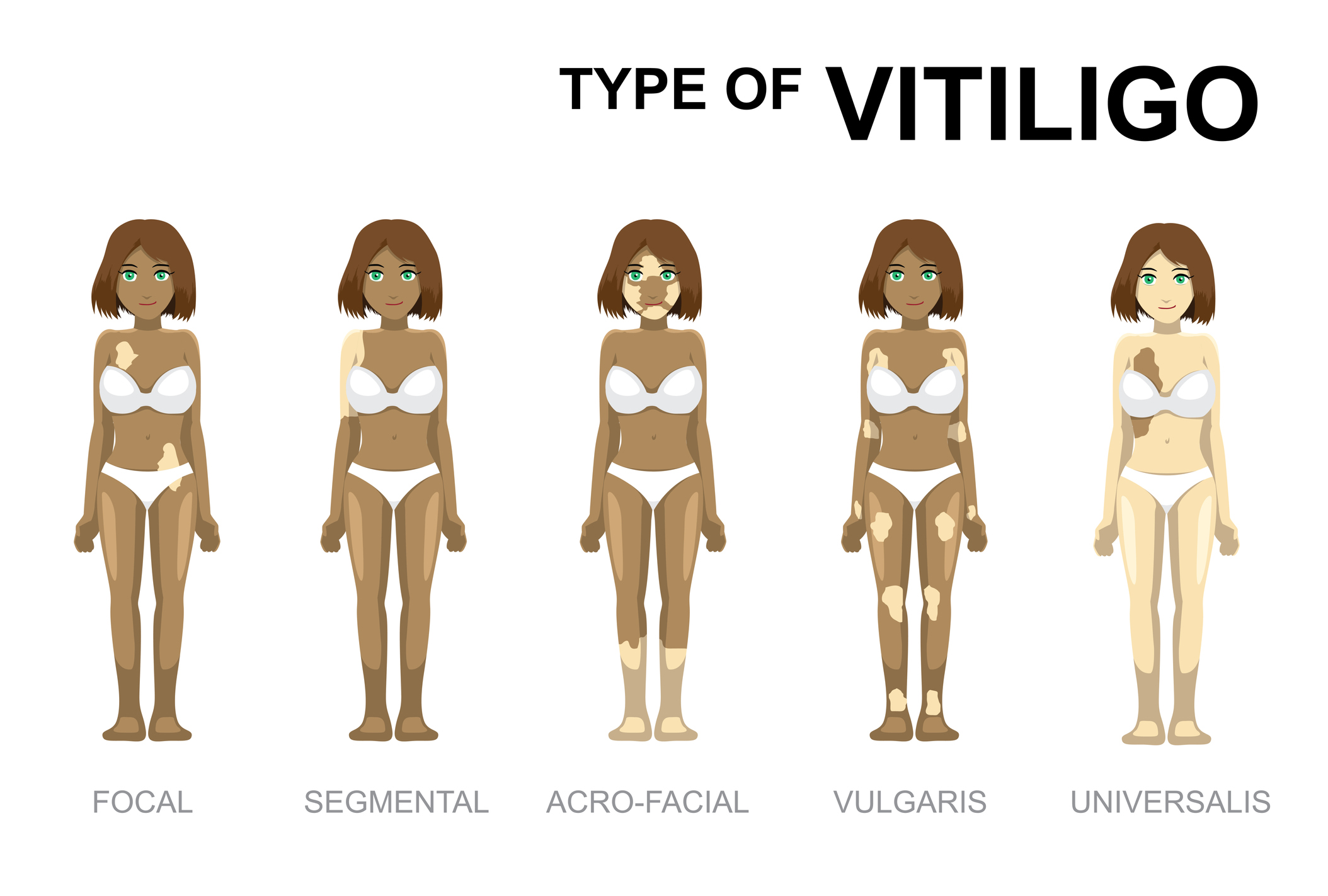 Tipuri de vitiligo