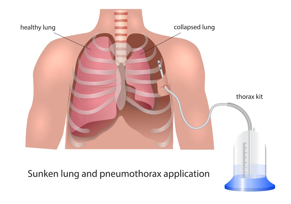 Vizualizarea drenajului pleural în pneumotorax: plămânul sănătos, plămânul colapsat și dispozitivul de drenaj