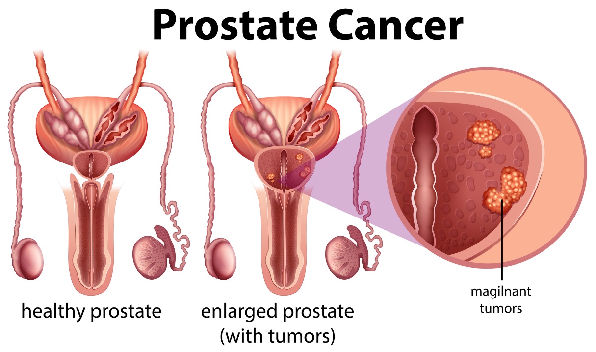 Cancer de prostată. Prostată sănătoasă și prostată mărită cu tumoare