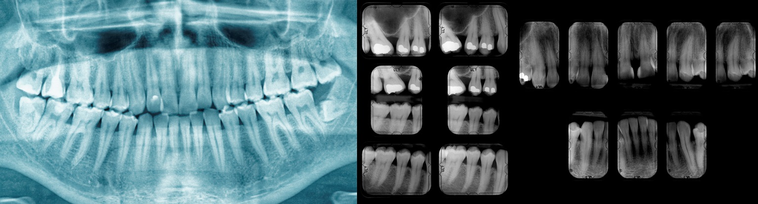 Radiografie dentară pentru a arăta starea dinților, cariile și obturațiile